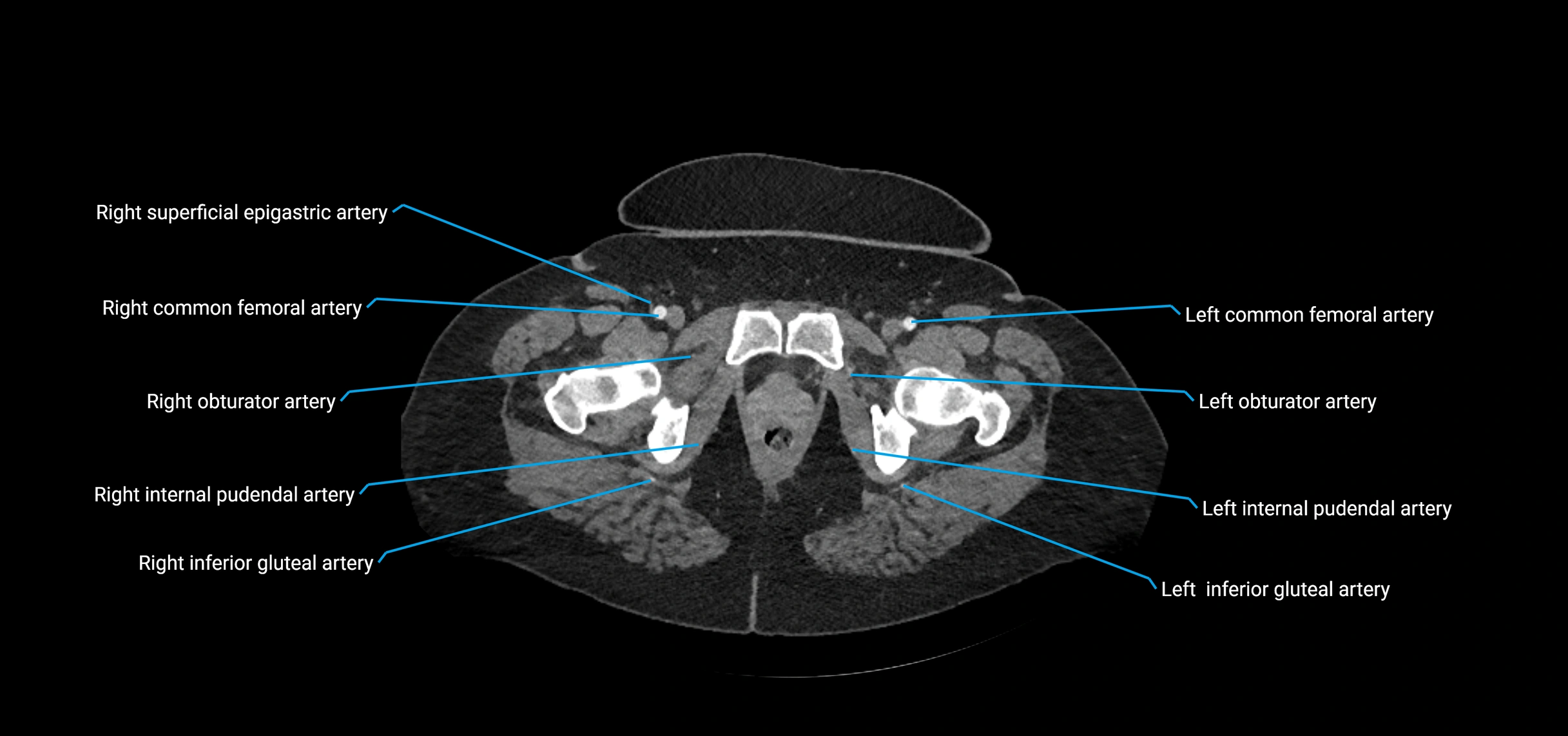 CTA abdomen axial cross sectional anatomy labelled image_260 (2).webp